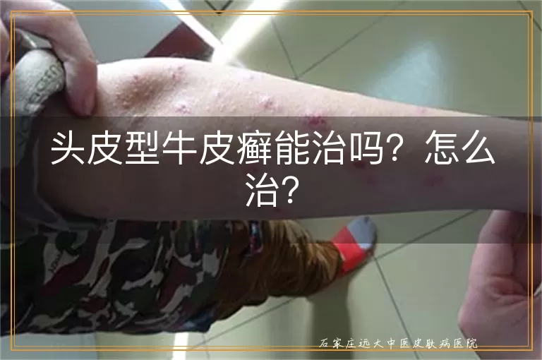 头皮型牛皮癣能治吗？怎么治？