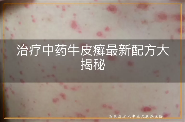 治疗中药牛皮癣最新配方大揭秘