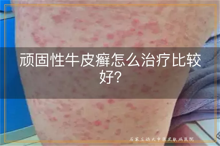 顽固性牛皮癣怎么治疗比较好？