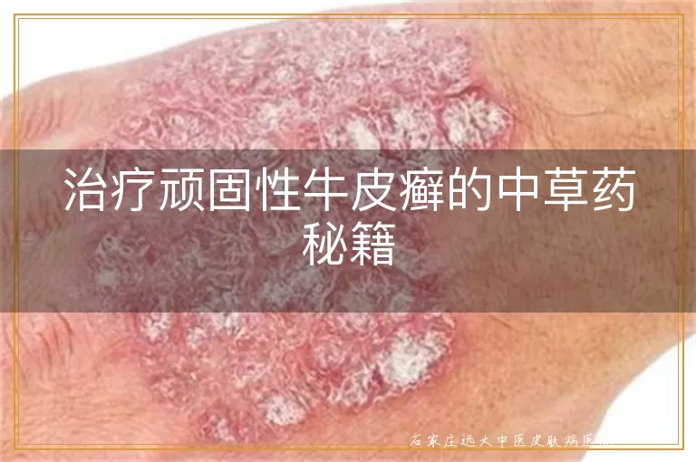 治疗顽固性牛皮癣的中草药秘籍