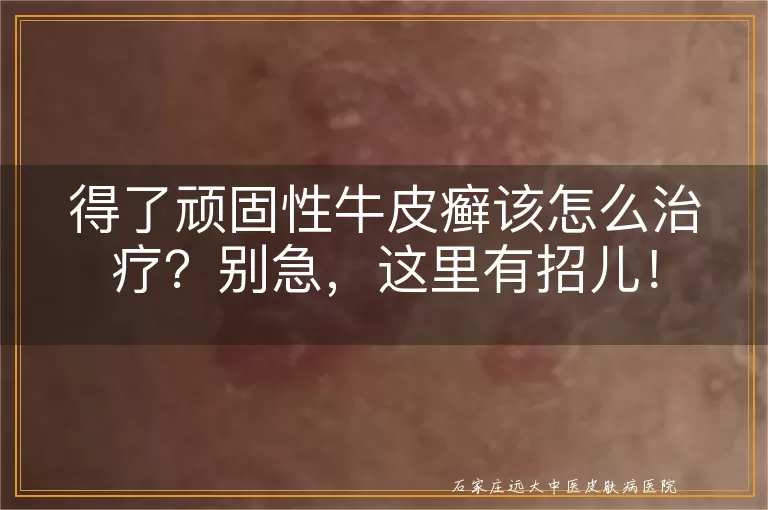 得了顽固性牛皮癣该怎么治疗?别急,这里有招儿!