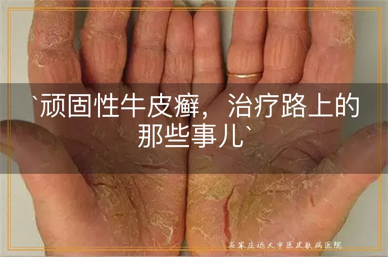 顽固性牛皮癣，治疗路上的那些事儿
