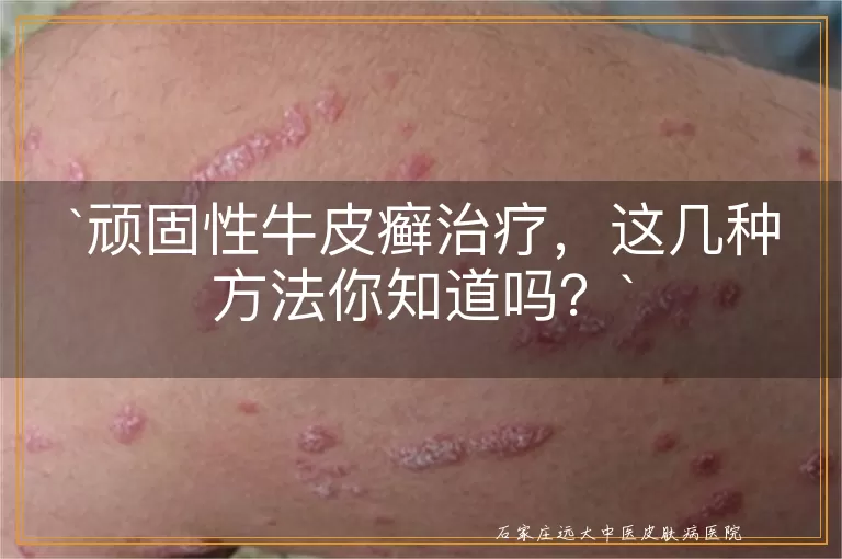 顽固性牛皮癣治疗，这几种方法你知道吗？