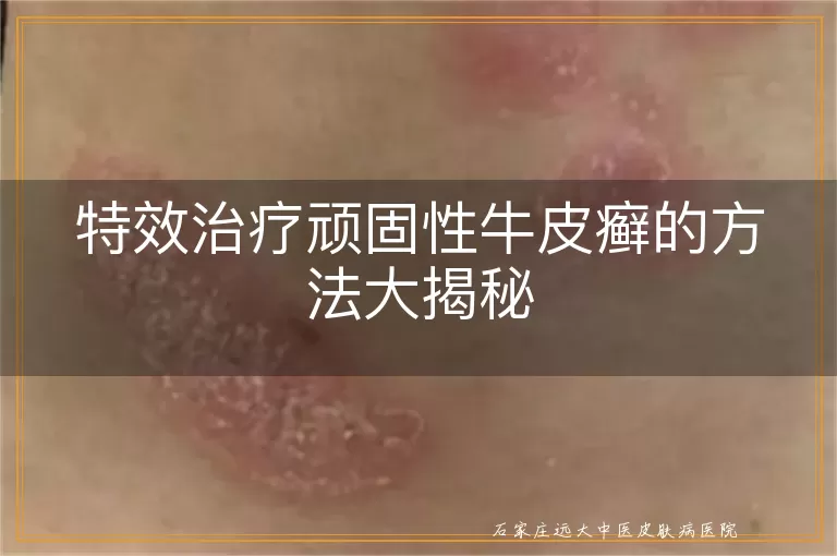 特效治疗顽固性牛皮癣的方法大揭秘
