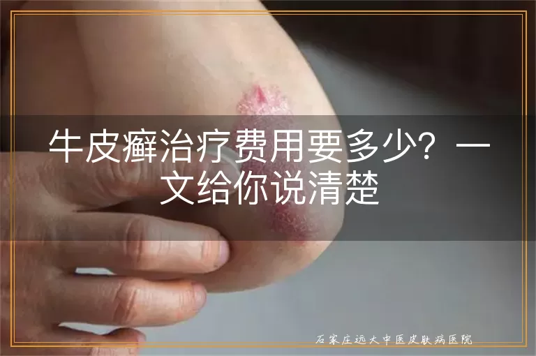 牛皮癣治疗费用要多少？一文给你说清楚