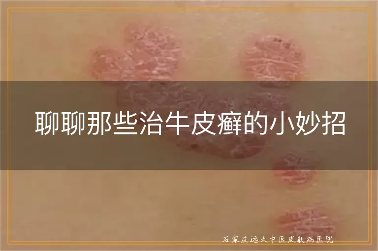 聊聊那些治牛皮癣的小妙招