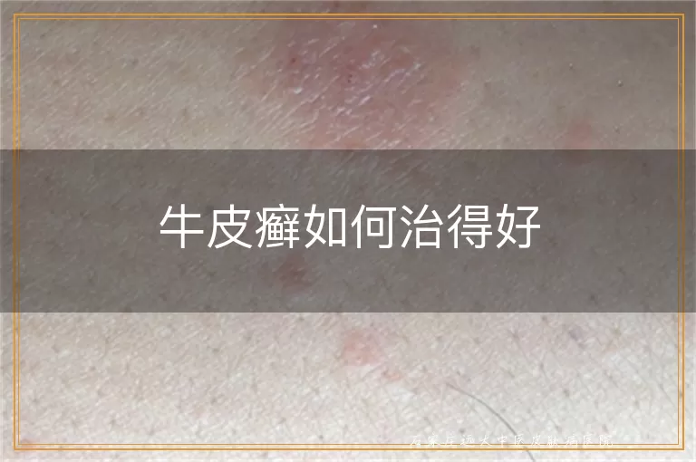 牛皮癣如何治得好