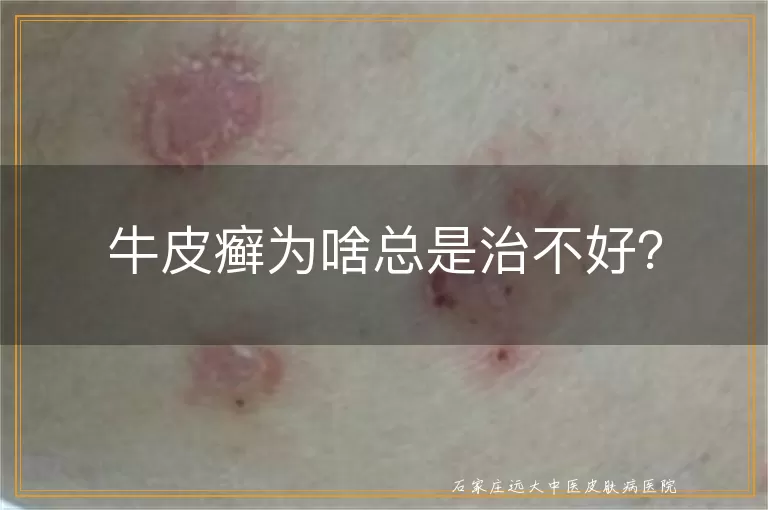 牛皮癣为啥总是治不好？