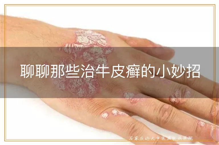 聊聊那些治牛皮癣的小妙招