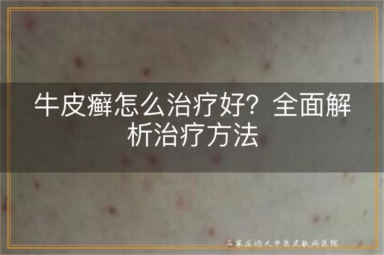 牛皮癣怎么治疗好？全面解析治疗方法