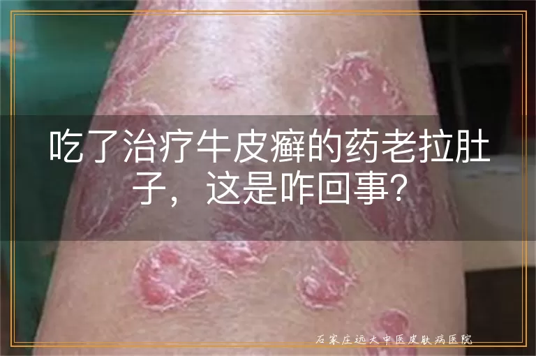 吃了治疗牛皮癣的药老拉肚子，这是咋回事？