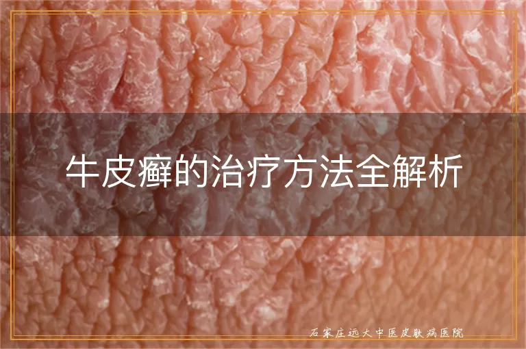 牛皮癣的治疗方法全解析
