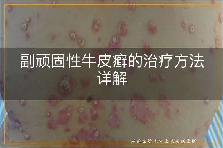 副顽固性牛皮癣的治疗方法详解