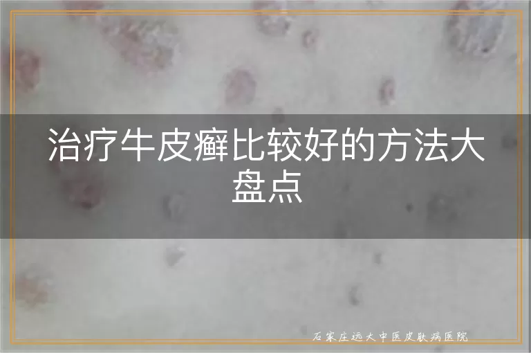 治疗牛皮癣比较好的方法大盘点