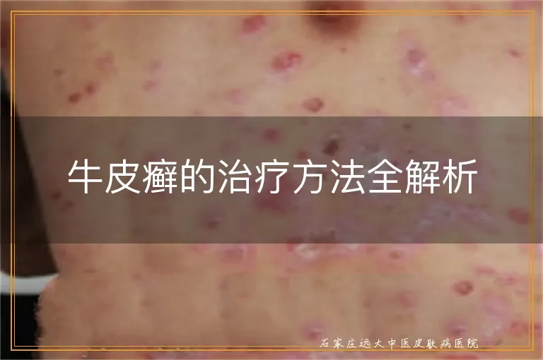 牛皮癣的治疗方法全解析