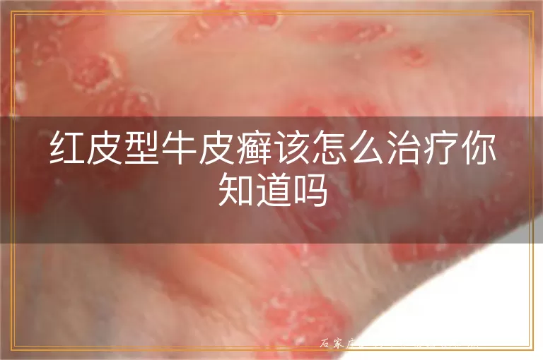 红皮型牛皮癣该怎么治疗你知道吗