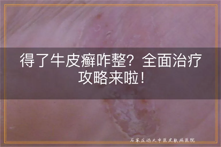 得了牛皮癣咋整？全面治疗攻略来啦！