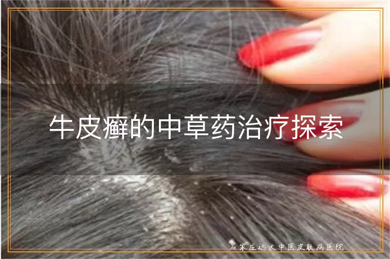 牛皮癣的中草药治疗探索