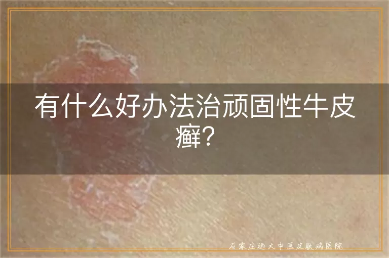 有什么好办法治顽固性牛皮癣？