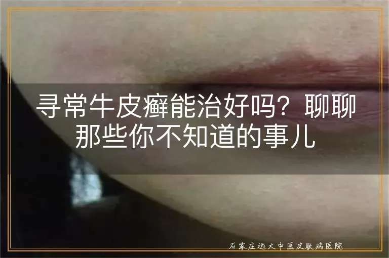 寻常牛皮癣能治好吗？聊聊那些你不知道的事儿