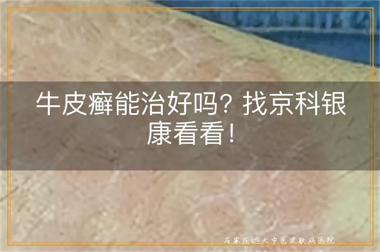 牛皮癣能治好吗? 找京科银康看看！