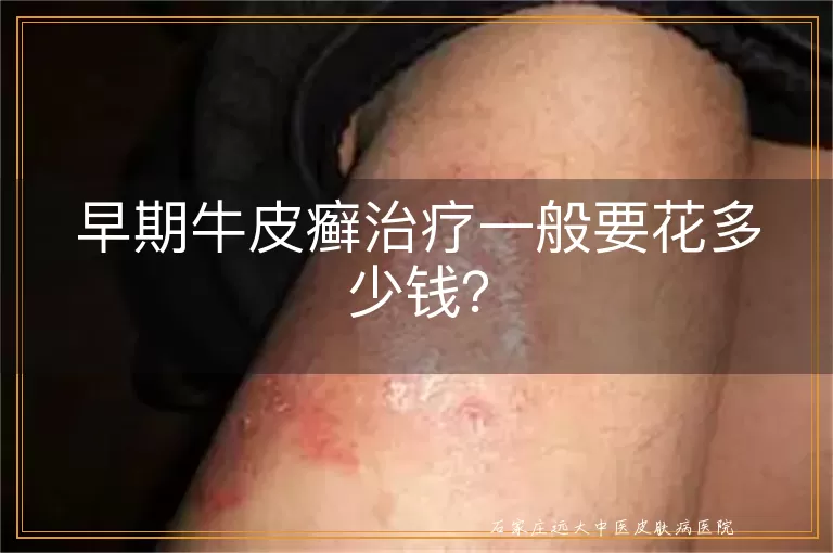 早期牛皮癣治疗一般要花多少钱？