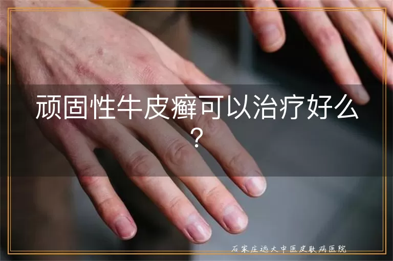 顽固性牛皮癣可以治疗好么？