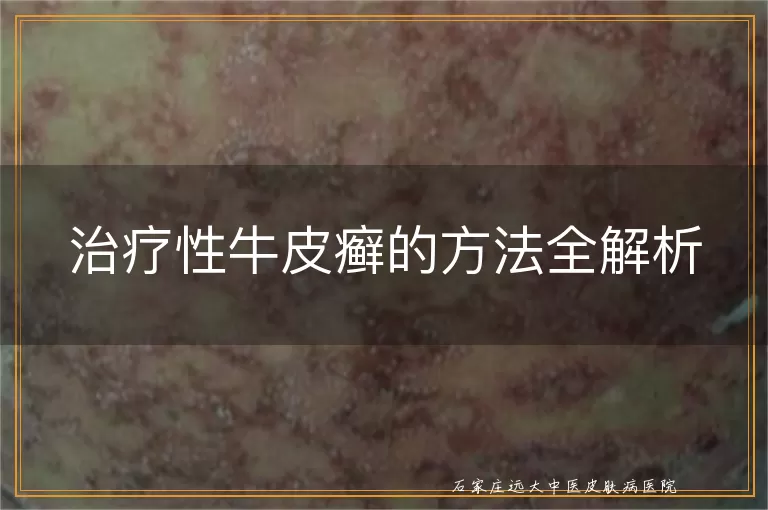 治疗性牛皮癣的方法全解析