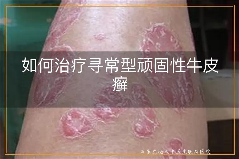 如何治疗寻常型顽固性牛皮癣