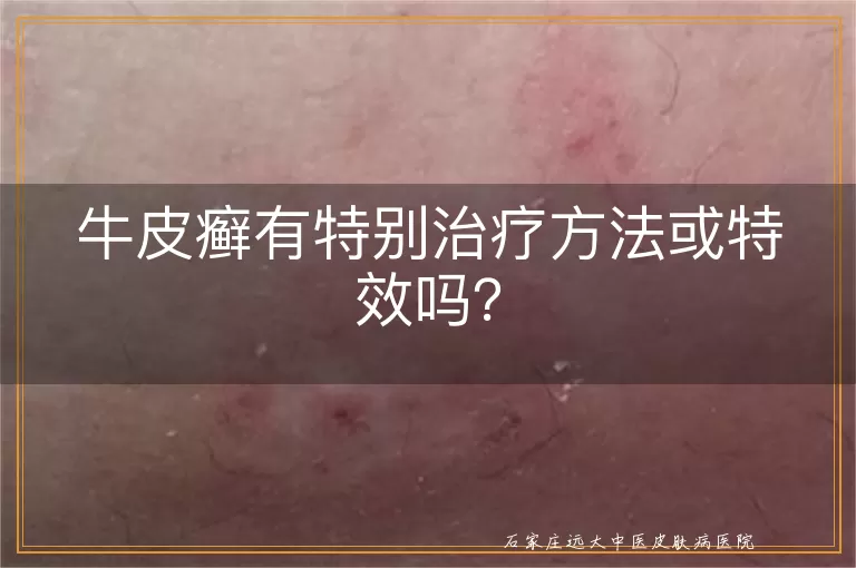 牛皮癣有特别治疗方法或特效吗？