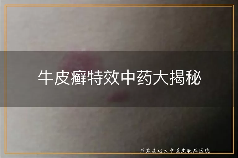 牛皮癣特效中药大揭秘
