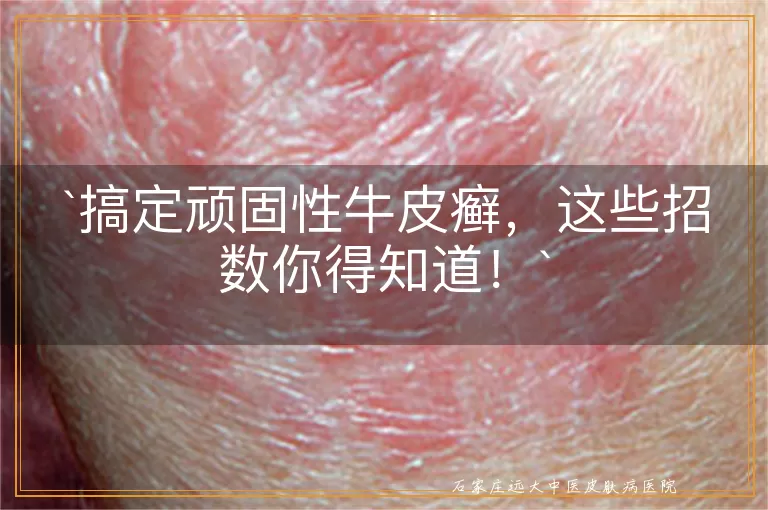 搞定顽固性牛皮癣，这些招数你得知道！