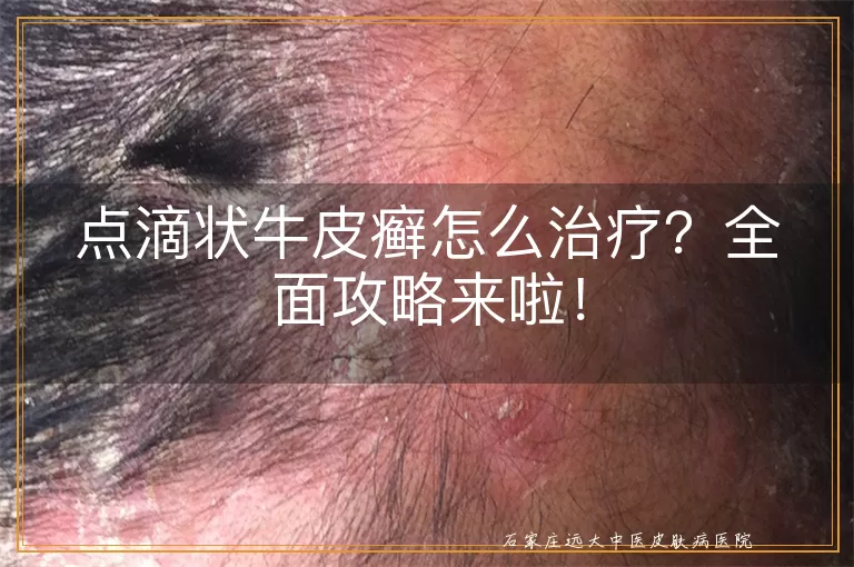 点滴状牛皮癣怎么治疗?全面攻略来啦!