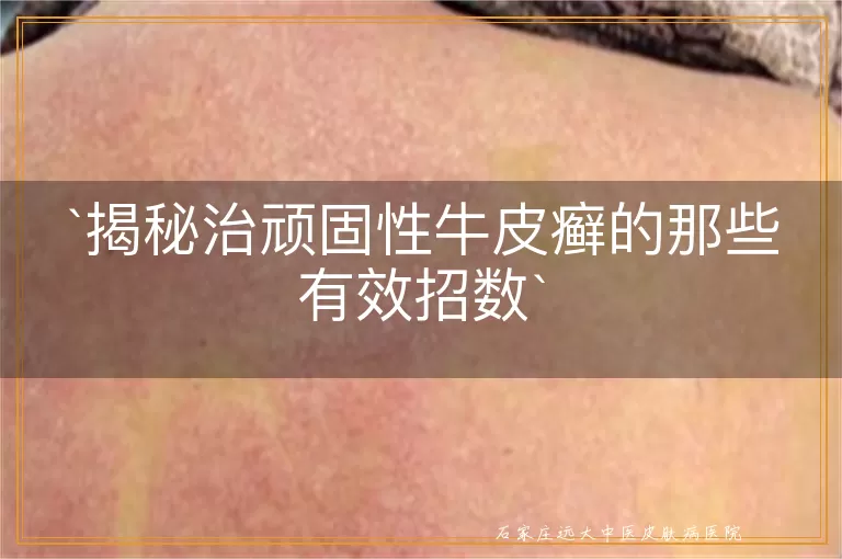 揭秘治顽固性牛皮癣的那些有效招数