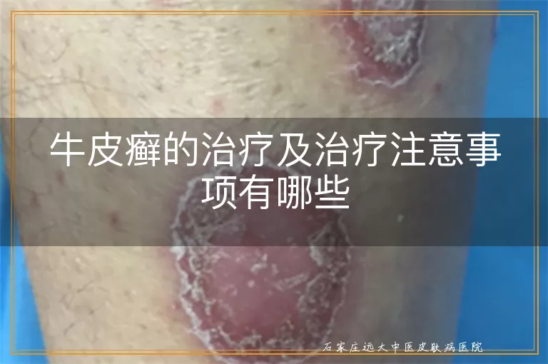 牛皮癣的治疗及治疗注意事项有哪些