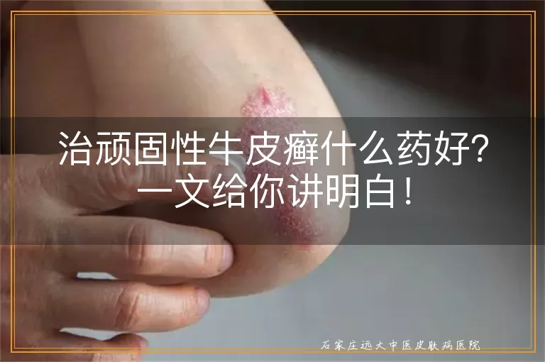 治顽固性牛皮癣什么药好？一文给你讲明白！