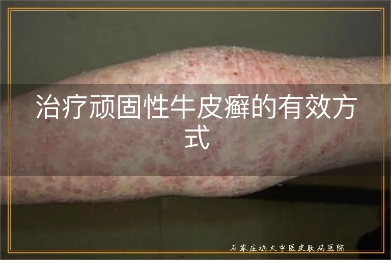 治疗顽固性牛皮癣的有效方式