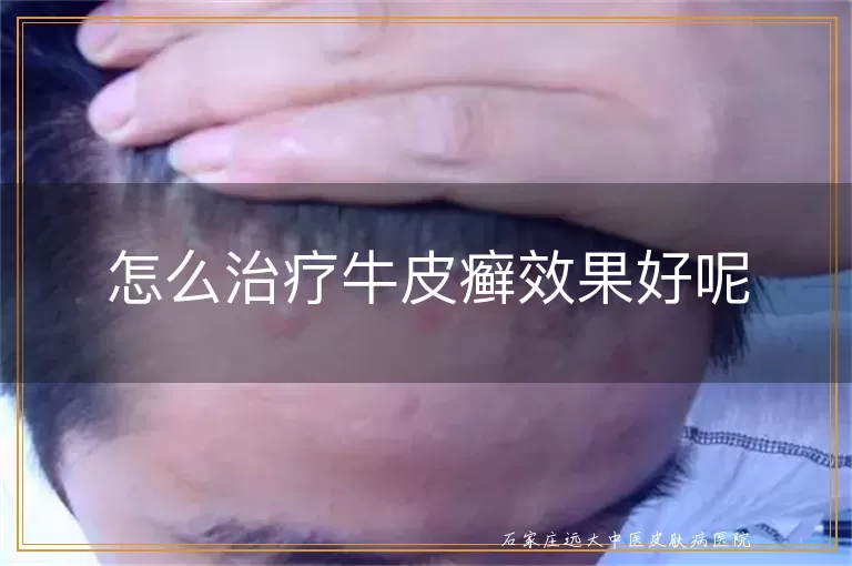 怎么治疗牛皮癣效果好呢
