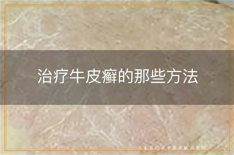 治疗牛皮癣的那些方法