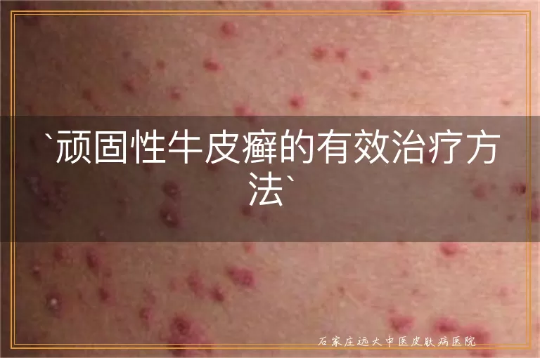 顽固性牛皮癣的有效治疗方法