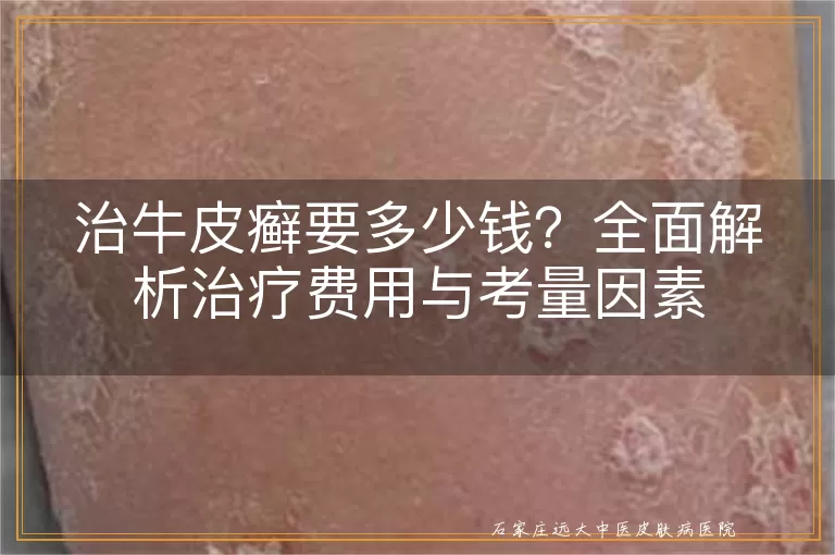 治牛皮癣要多少钱?全面解析治疗费用与考量因素