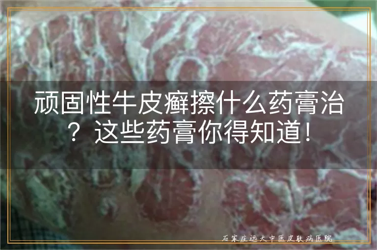 顽固性牛皮癣擦什么药膏治?这些药膏你得知道!