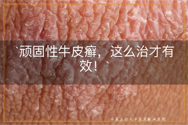 顽固性牛皮癣，这么治才有效！