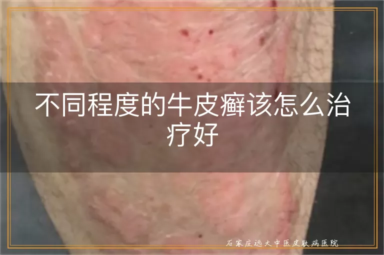 不同程度的牛皮癣该怎么治疗好