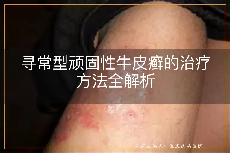 寻常型顽固性牛皮癣的治疗方法全解析