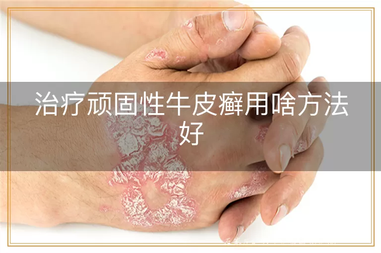 治疗顽固性牛皮癣用啥方法好