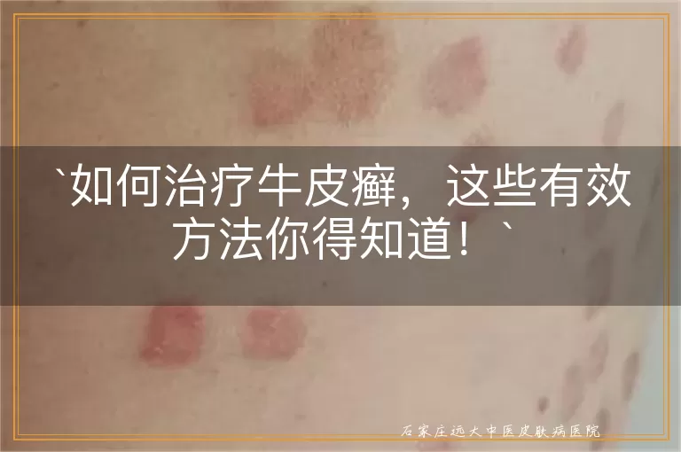 如何治疗牛皮癣，这些有效方法你得知道！