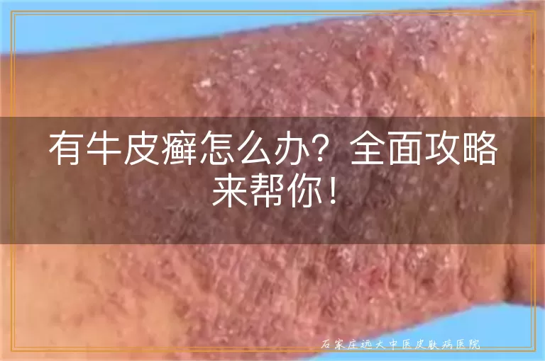 有牛皮癣怎么办？全面攻略来帮你！