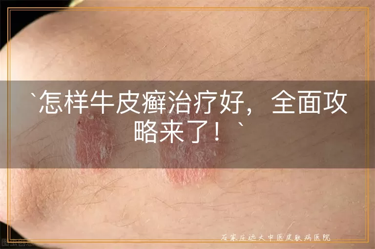 怎样牛皮癣治疗好，全面攻略来了！