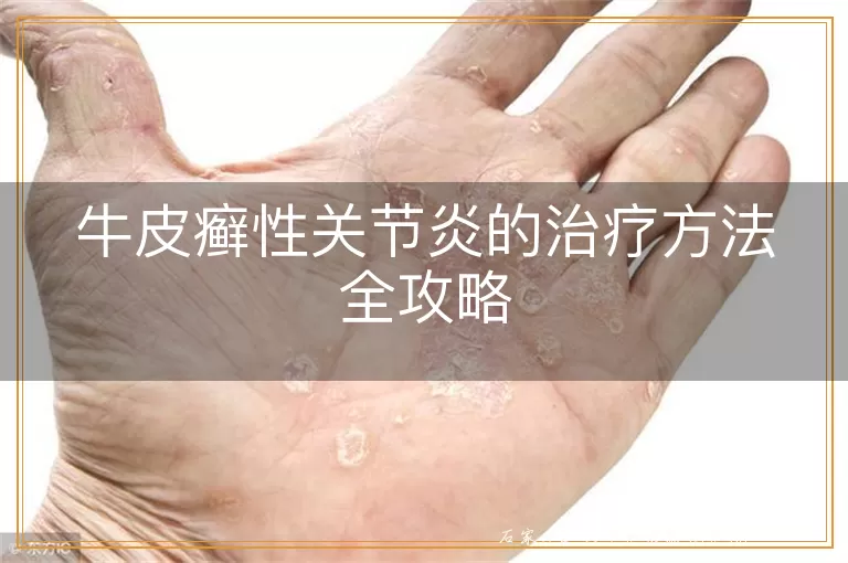 牛皮癣性关节炎的治疗方法全攻略